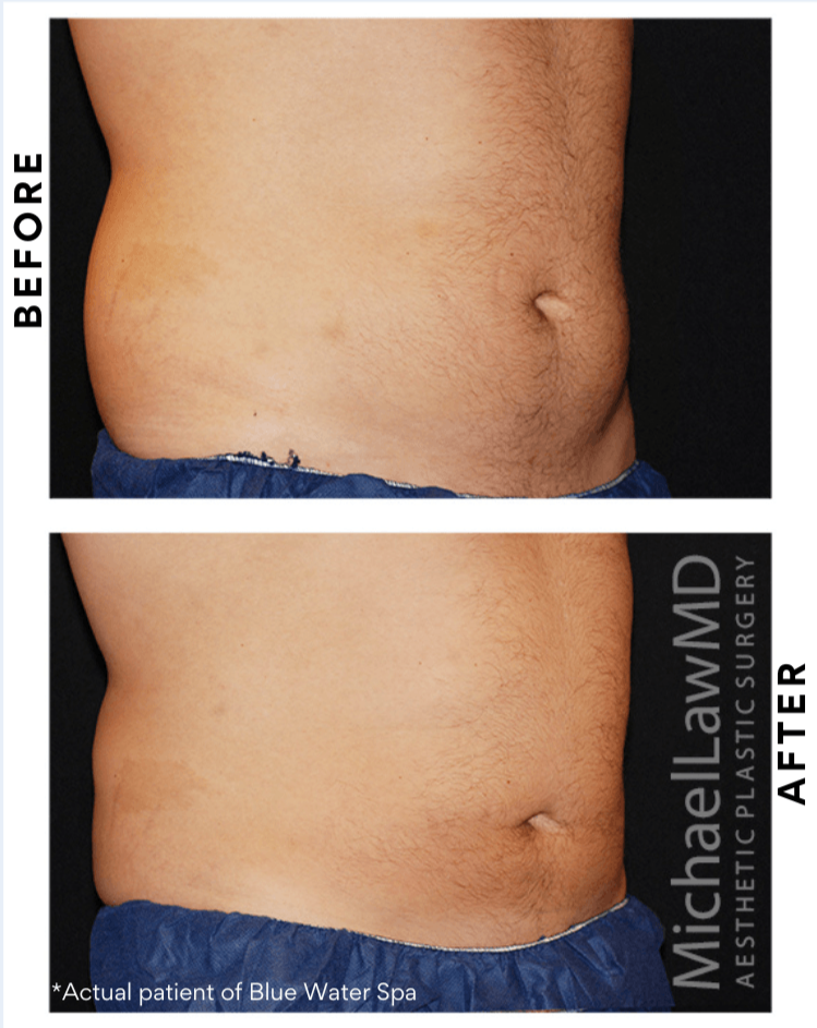 CoolSculpting  Perfection Plastic Surgery And Skin Care