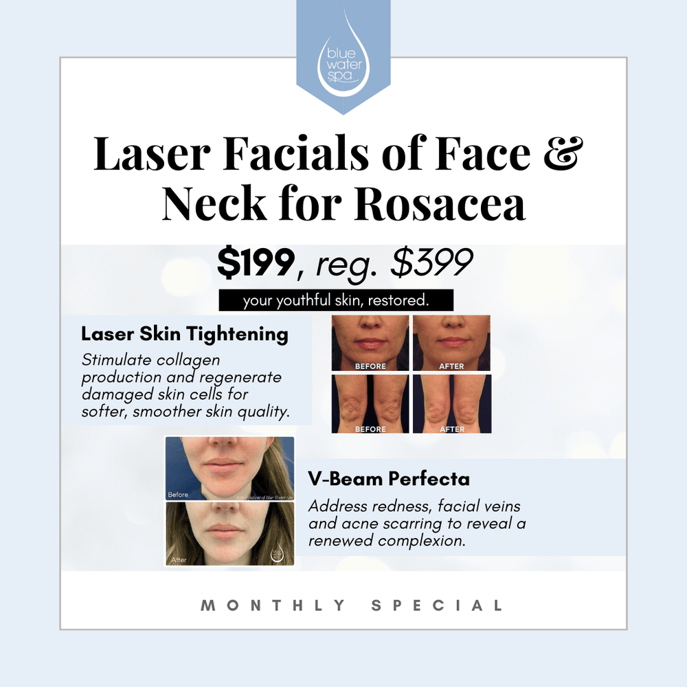 Treatments-Laser Facials for Rosacea-Blue Water Spa