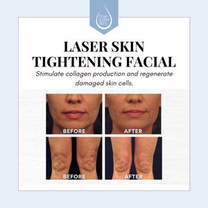 Treatments-Laser Skin Tightening-Blue Water Spa