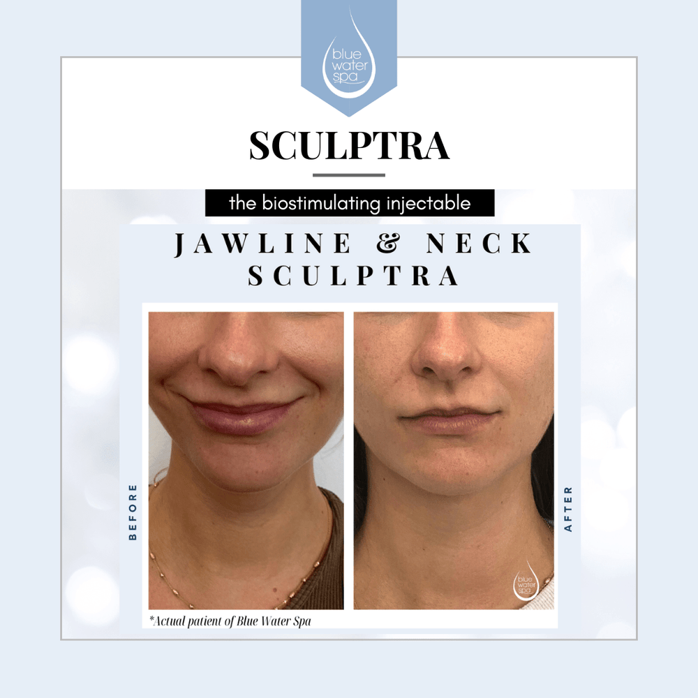 Facial Treatments - Sculptra - Blue Water Spa