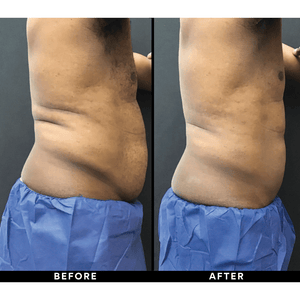 
            
                Load image into Gallery viewer, Body Treatments-2-for-1 CoolSculpting-Blue Water Spa
            
        