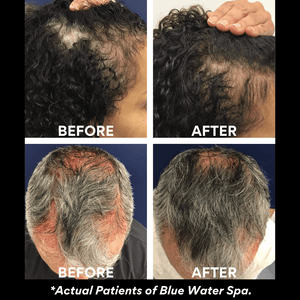Body Treatments-PRF for Hairloss-Blue Water Spa