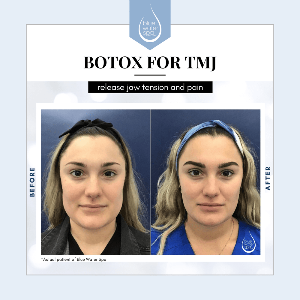 Face Treatments-Botox Treatments for TMJ-Blue Water Spa