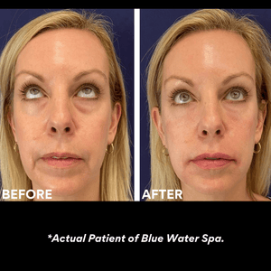 
            
                Cargar imagen en el visor de la galería, Facial Treatments-PRF Injections (Birthday)-Blue Water Spa
            
        