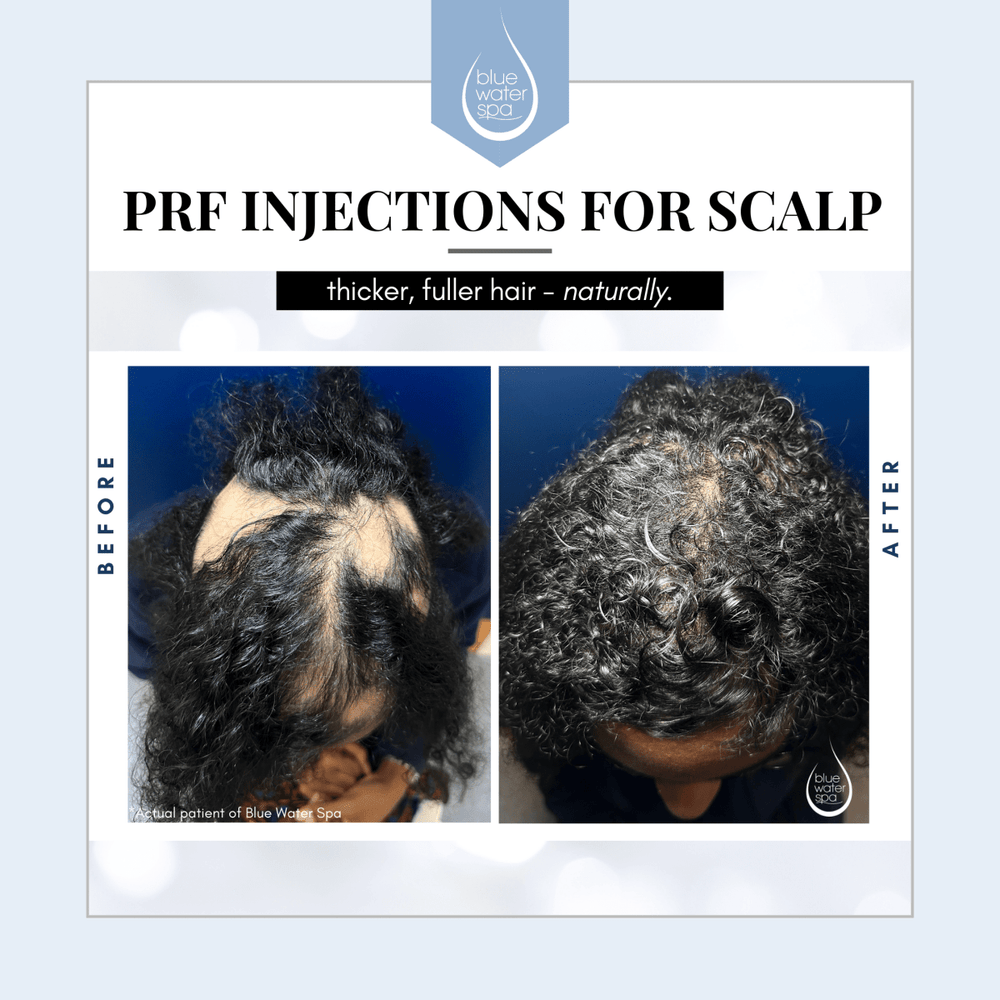 
            
                Load image into Gallery viewer, Facial Treatments-PRF Injections for Hairloss-Blue Water Spa
            
        