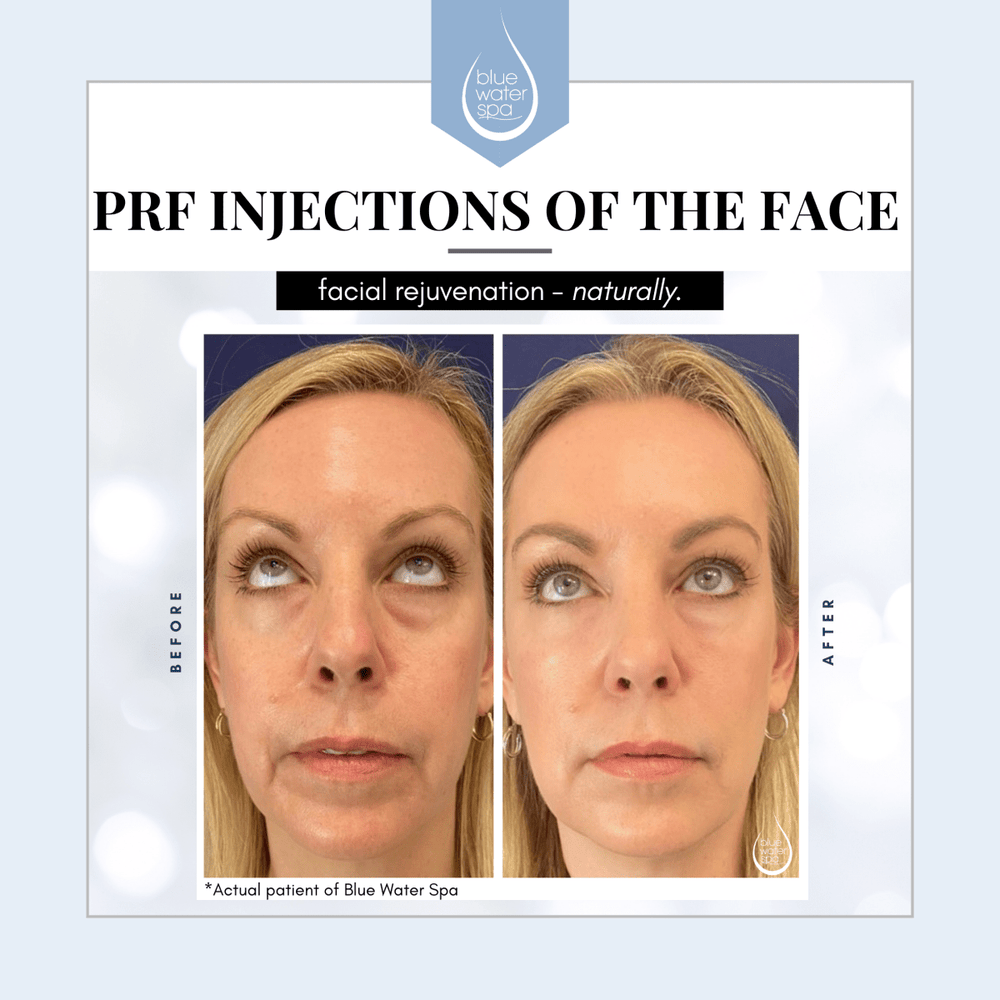 Facial Treatments-PRF Injections of the Face-Blue Water Spa