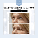 Facial Treatments-PRF Injections of the Tear Troughs-Blue Water Spa