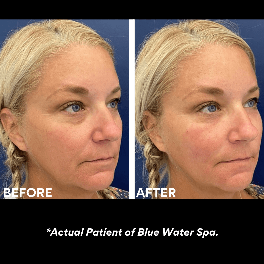 PRF Injectable Treatments | Natural Facial Rejuvenation at Blue Water Spa