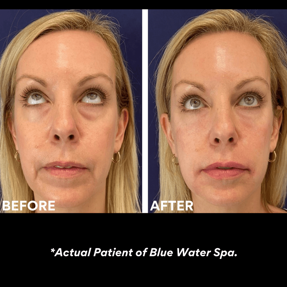 Facial Treatments-PRF Injections (VIP)-Blue Water Spa