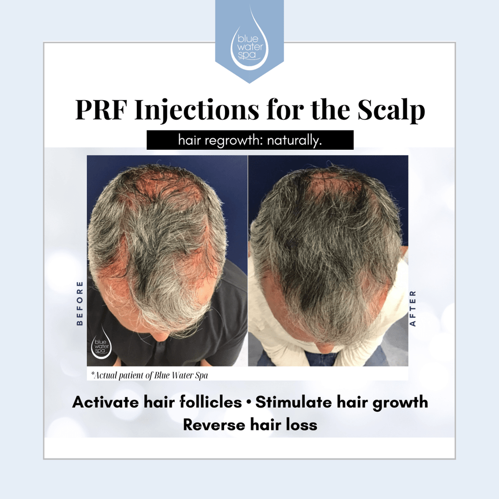 Facial Treatments-Series of 3 PRF Injections for Hairloss-Blue Water Spa