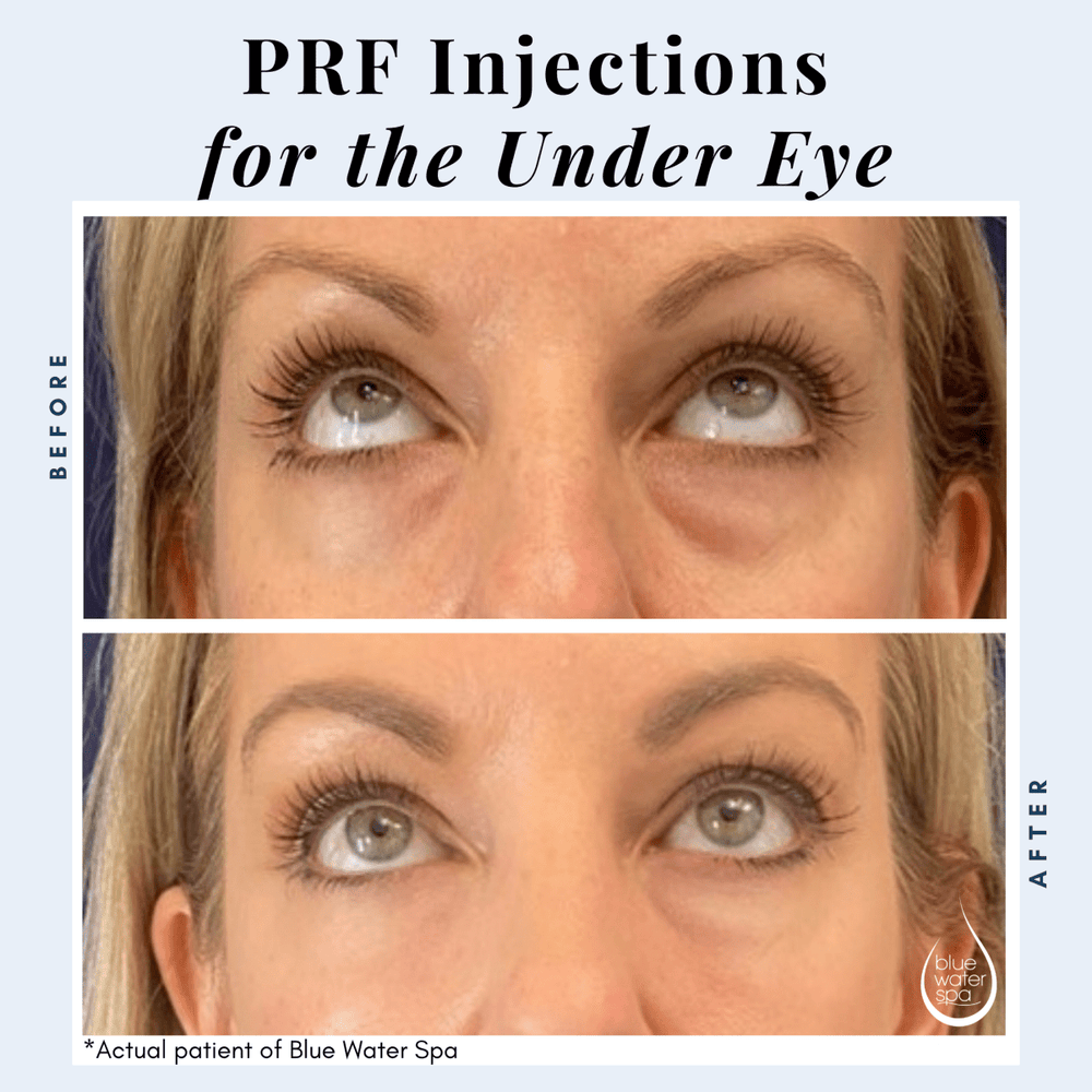 PRF Eye Area Rejuvenation | PRP Injections at Blue Water Spa