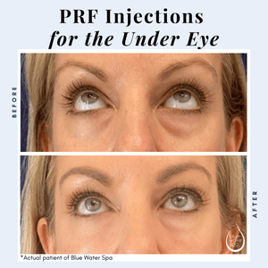 Facial Treatments-Series of PRF Injections of the Tear Troughs-Blue Water Spa