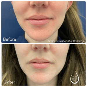 Facial Treatments-V-Beam Perfecta Laser: Full Face-Blue Water Spa