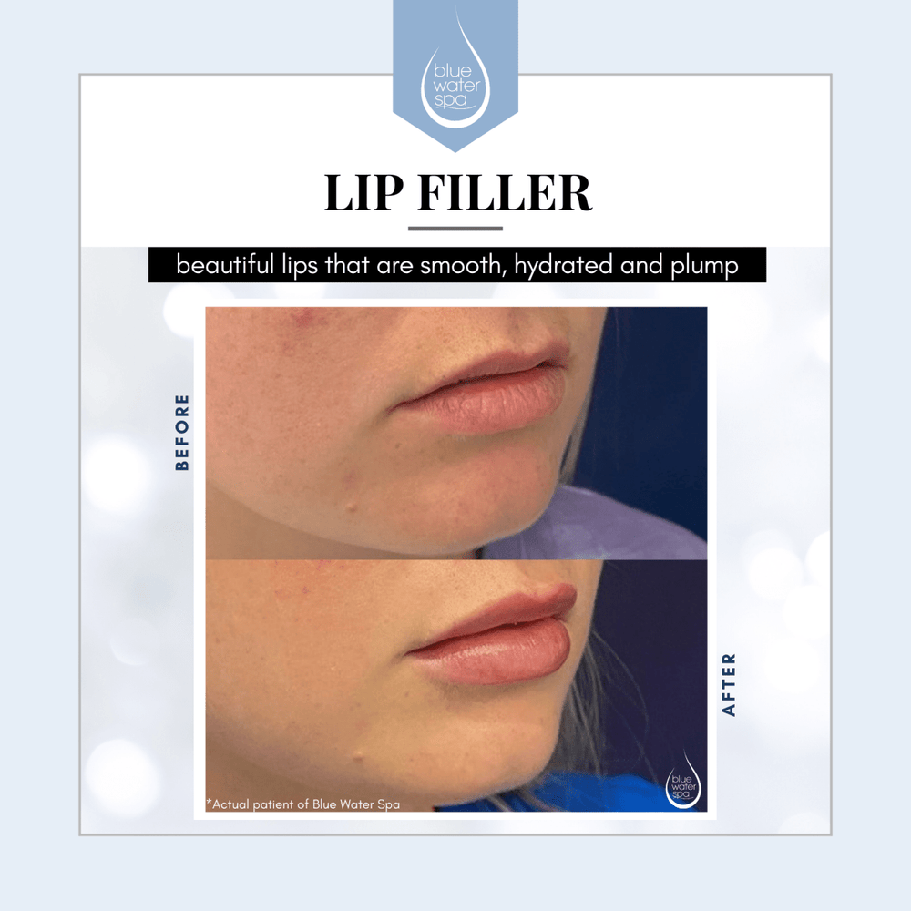 Gift Cards-Lip Filler E-Gift Card-Blue Water Spa