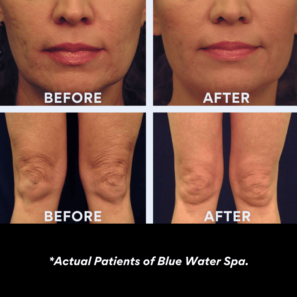 Treatments-Laser Skin Tightening: Half Face or Neck-Blue Water Spa