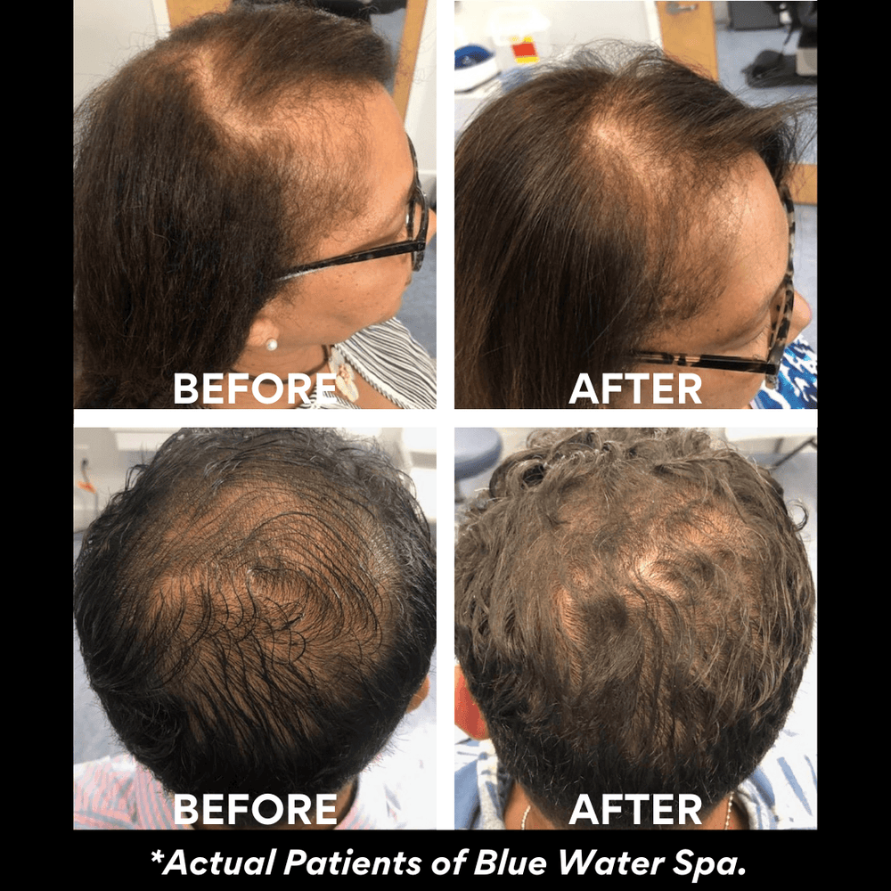
            
                Load image into Gallery viewer, Treatments-PRF for Hairloss (Birthday Collection)-Blue Water Spa
            
        