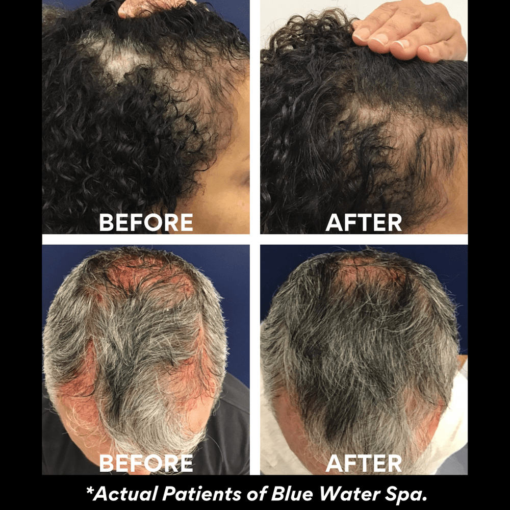 
            
                Load image into Gallery viewer, Treatments-PRF for Hairloss (Birthday Collection)-Blue Water Spa
            
        